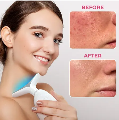 Aiven ContourLift Sculptor Beore After